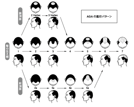 AGAの進行パターン