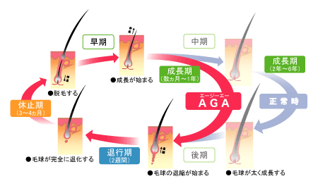 AGAの原因