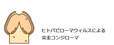尖圭コンジローマ